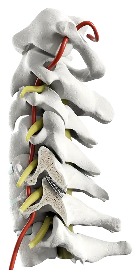 rectore-c-expandable-implant-in-spine-lateral-450 Restore-C Study: Expandable Implant in spine, lateral.
